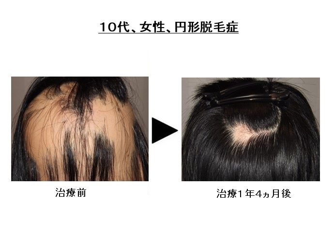 円形脱毛症　病院